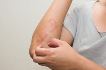 stock-photo-ill-allergic-rash-dermatitis-eczema-skin-of-patient