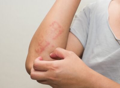 stock-photo-ill-allergic-rash-dermatitis-eczema-skin-of-patient